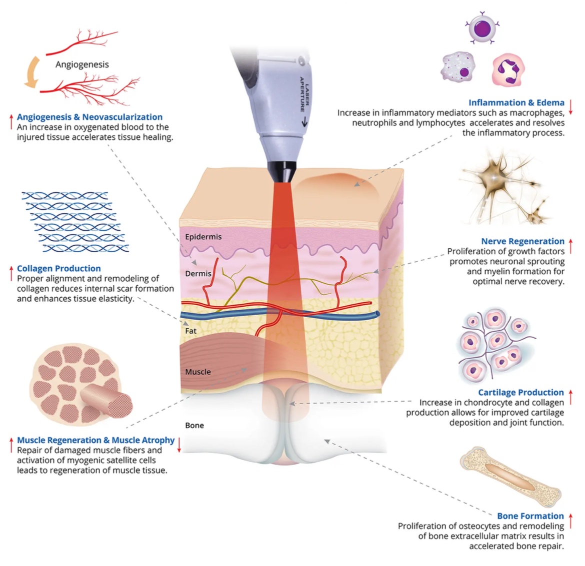 Effects of Laser Therapy